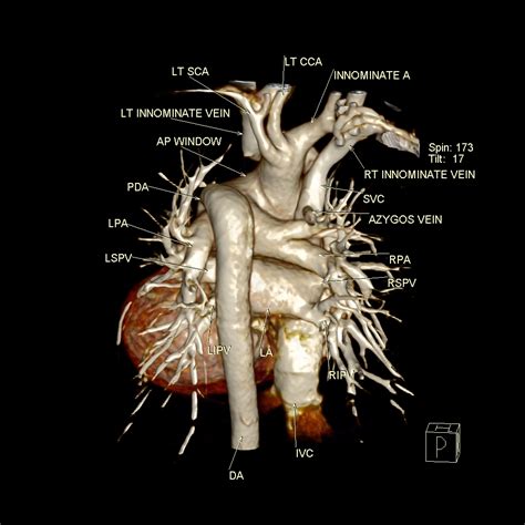 ap window aortic arch.